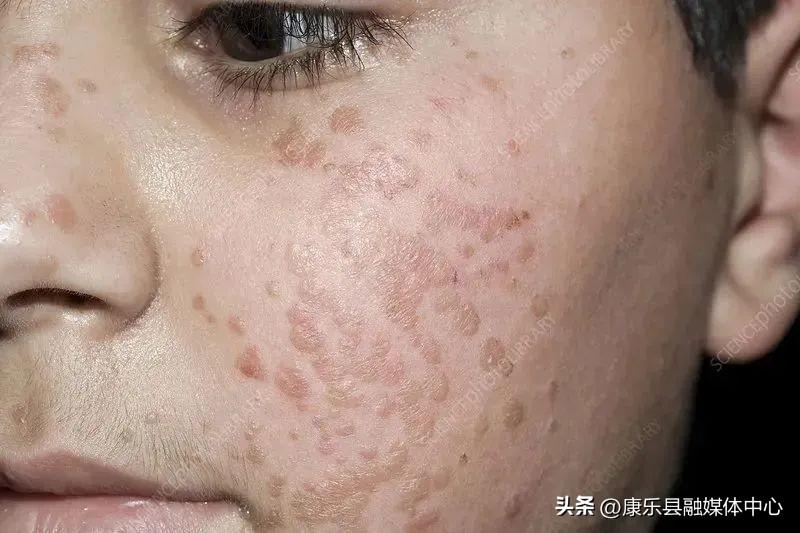 身上長了HPV，我們?cè)撊绾蚊鎸?duì)與處理